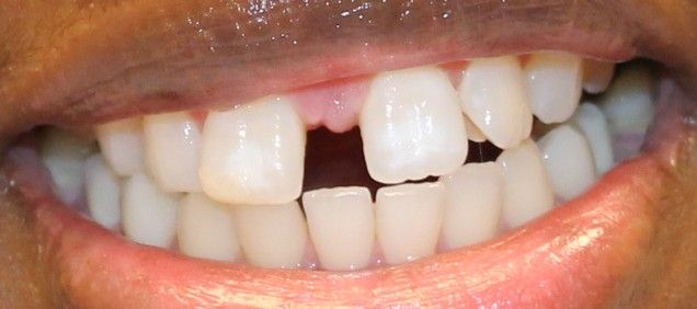 Before Invisalign Crowding & Alignment Beverly Chicago