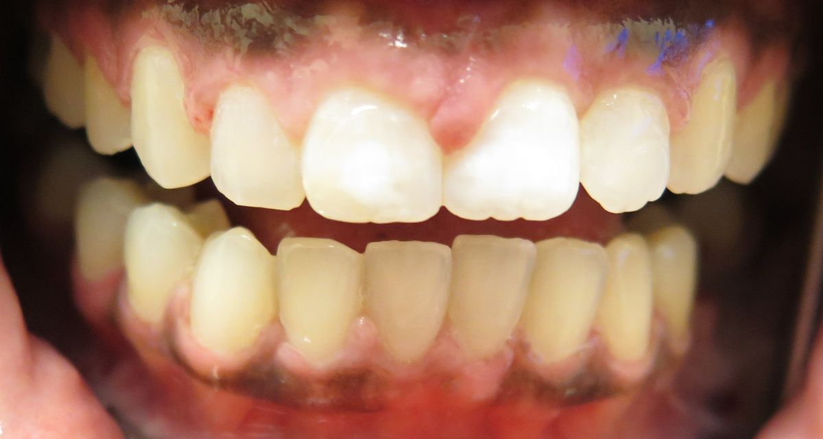 After Invisalign Crowding & Alignment Beverly Chicago
