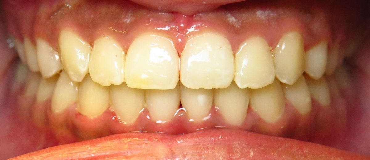 After Invisalign Crowding & Bite Correction Beverly Chicago