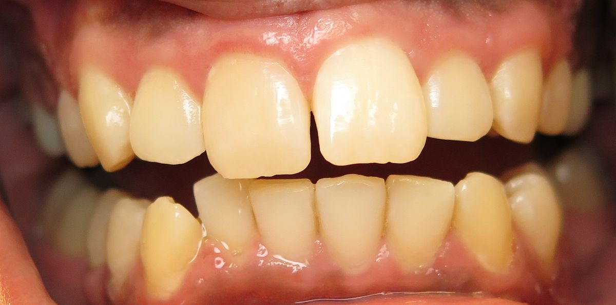 Before Invisalign Spacing & Gum Health Beverly Chicago